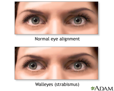 Eye muscle repair