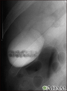 Gallstones, cholangiogram