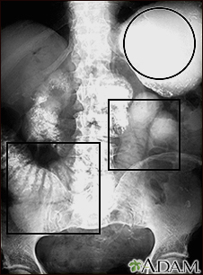 ileus distended peristalsis bowel intestinal swollen obstruction anus imperforate paralitik artefact 1169 medlineplus kharisma fajar