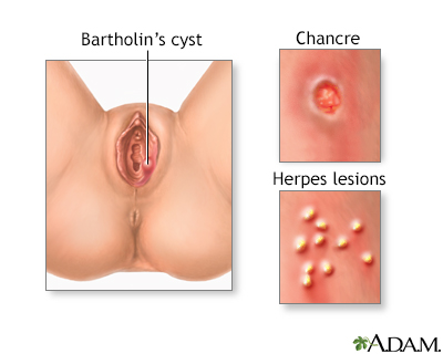 Genital sores - female