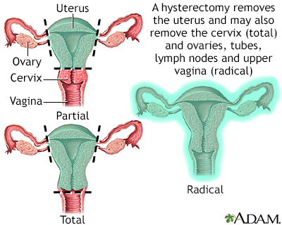 Hysterectomy - vaginal - discharge