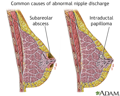 excretions from the breast Excretions from the breast