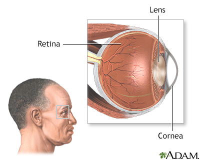 retinitis definition