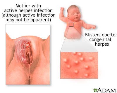 Herpes Pictures - Herpes & Cold Sores Support Network