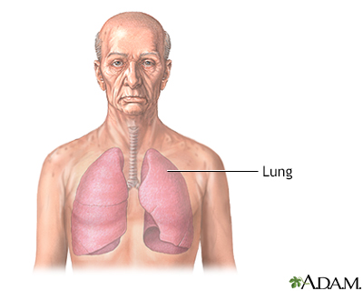 Steroids used for pneumonia