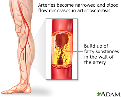 Hardening Of The Arteries Of The Legs