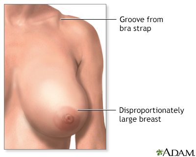 reduction augmentation include does breast breast