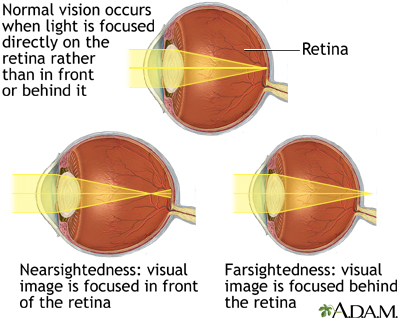 Visual Acuity Test