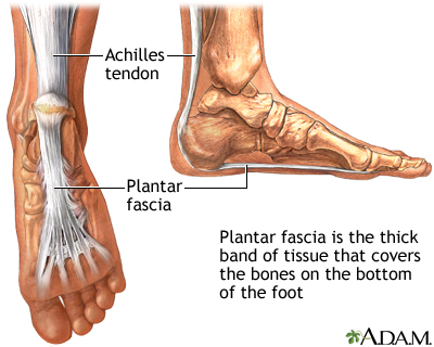 Arch Pain