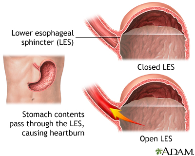 Acid+reflux+disease