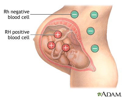 Rh incompatibility and sperm