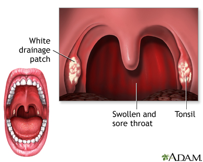 throat strep sore definition