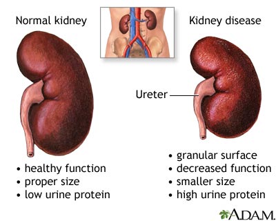 Kidney failure steroid use