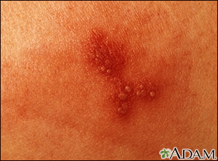 Genital Herpes Pictures | Is your sore herpes?