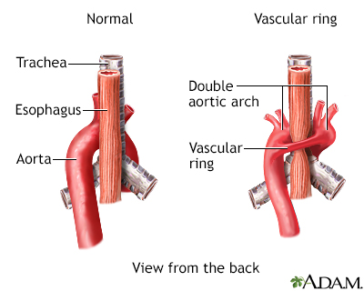 aortic arch definition