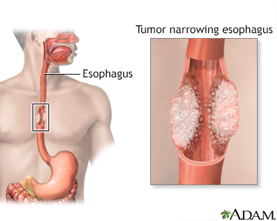 Esophagectomy Open