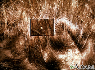 Head Lice