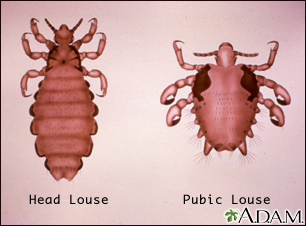 Pubic Lice