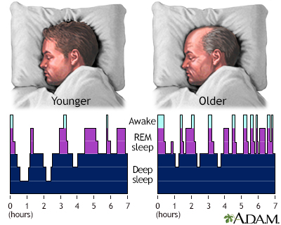 cataplexy sleep disorder