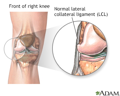 Torn Lcl Mri