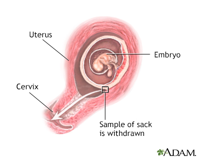 chorionic villus sampling chorionic villus sampling
