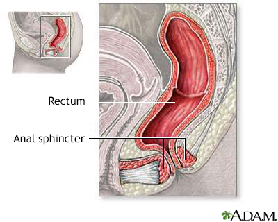 Inflatable artificial anal sphincter indiana