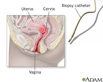 Endometrial biopsy infection