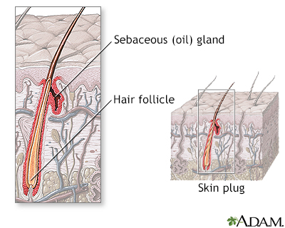 Trichorrhexis nodosa alopecia skin diagram 