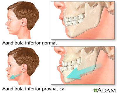 Oclusion Dental Defectuosa