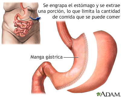 Gastrectomia Vertical En Manga