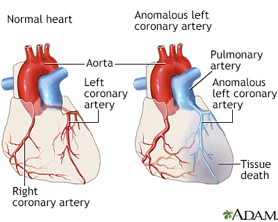 Anomalous left coronary artery from the pulmonary artery